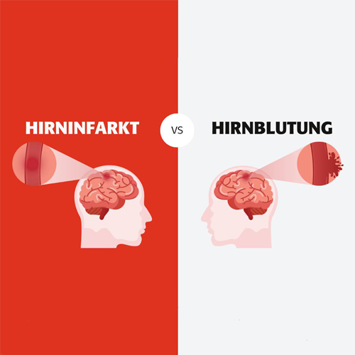 Infografik zum Unterschied zwischen Hirninfarkt und Hirnblutung