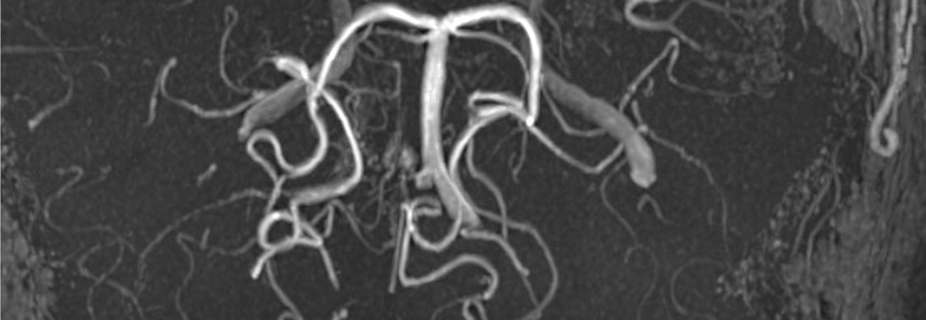 Moyamoya Fehldiagnosen Konnen Fatale Folgen Haben